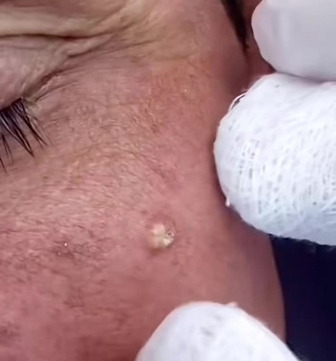 ASMR Pimple Popping Compilation | Blackheads, Zits, and Pimples | Cravos e Espinhas