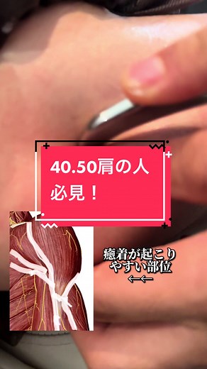 #40肩#50肩#四十肩#五十肩 #肩板損傷#肩板断裂