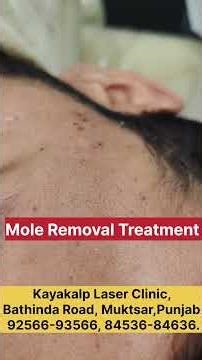How Dermatologists Remove Moles Perfectly #moleremoval #laser