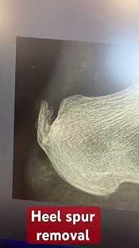 Heel spur removal post op visit