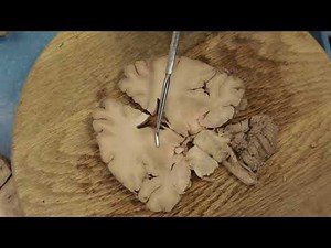 Coronal Brain Dissection
