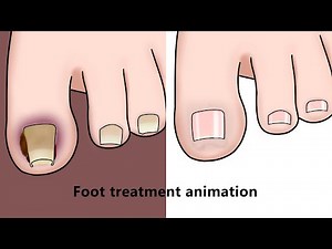 내성 발톱 케어 Paronychia Curing Stop Motion ASMR丨Meng's Stop Motion