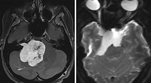 Retromastoid Craniotomy | Cohen Collection | Volumes | The Neurosurgical Atlas