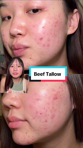 Beef Tallow Acne Treatment Experience | Update and Results