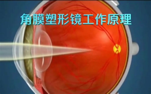 角膜塑形镜原理