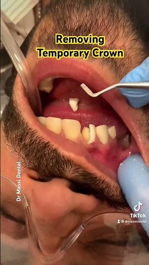 Removing Temporary Crown