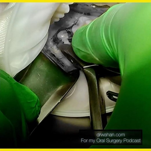 Surgical Extraction with Root Sectioning