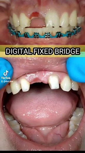 REPLACING PORCELAIN FUSED TO METAL MARYLAND BRIDGE TO DIGITAL PMMA BRIDGE #dentaltips #denture