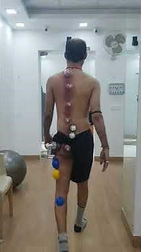 Cupping for Sciatica RELIEF !