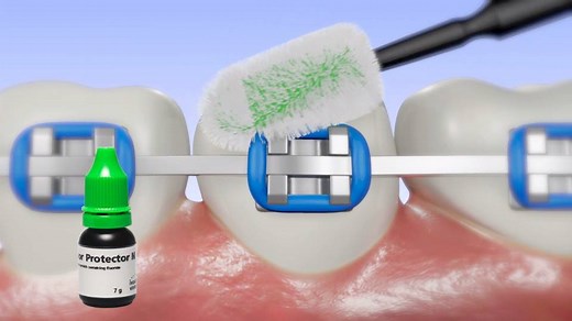 The varnish for an immediate fluoridation. Fluor Protector N offers superior protection against dental caries and erosion. The fluoride component is completely dissolved and thus evenly distributed within the product. Fluor Protector N exhibits excellent flow and wetting properties and is relatively moisture tolerant during application. The fluoride varnish is applied by a dental professional in the dental office or under field conditions. Indication • Treatment of hypersensitive cervicals • Imp