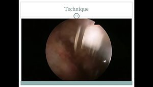 Subscapularis tears and comma sign: are we talking about the same thing?