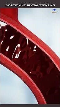 Aortic Dissection stenting medical video ///