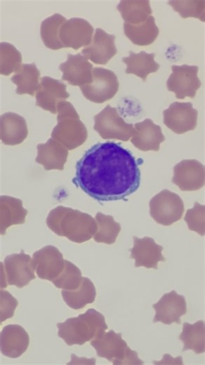 Mustafa Elsobky on Instagram: "Reactive Lymphocyte With Blebs : Notable for cytoplasmic blebs or Projections / Case of + FIV / Blood Smear Cytology ✨🔬"