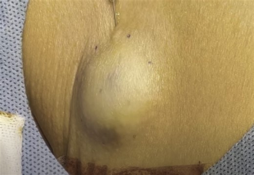 Creamy Epidermal Cyst Incision and Drainage