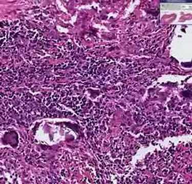 Histopathology Temporal artery --Temporal arteritis