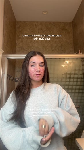Finding Relief on Accutane: A Realistic Journey