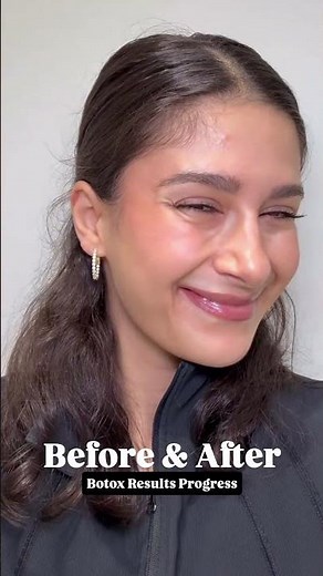 Wrinkle relaxers Before and After | What to Expect from Anti-Wrinkle Treatment