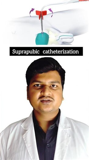 Suprapubic catheterization | Emergency Procuder In ICU #icuwalla