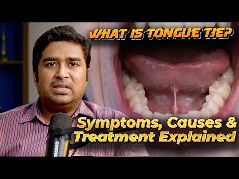What Is Tongue Tie? Symptoms, Causes & Treatment Explained | Dr Vignesh ENT