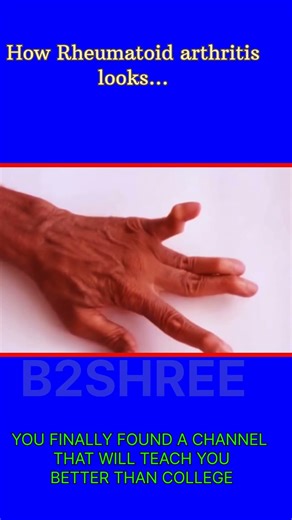Rheumatoid arthritis symptoms#arthritis #medical