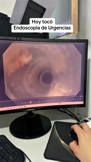🧠🥖 Atragantamiento esofágico: por qué el sobretubo importa Cuando un alimento queda atorado en el esófago, la endoscopia debe ser rápida, precisa y segura. Aquí es donde el sobretubo cobra un papel clave 🔑. 🛡️ Este dispositivo protege el esófago durante la extracción del bolo alimentario, permitiendo múltiples entradas del endoscopio sin dañar la mucosa. 🫁 Además, disminuye el riesgo de aspiración y mejora el control del procedimiento en situaciones de urgencia. 🧪 Está fabricado con materi