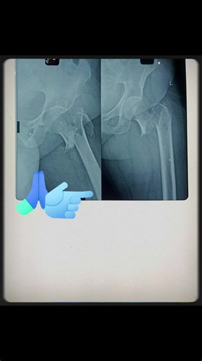 Understanding Difficult Inter-trochanteric Fractures