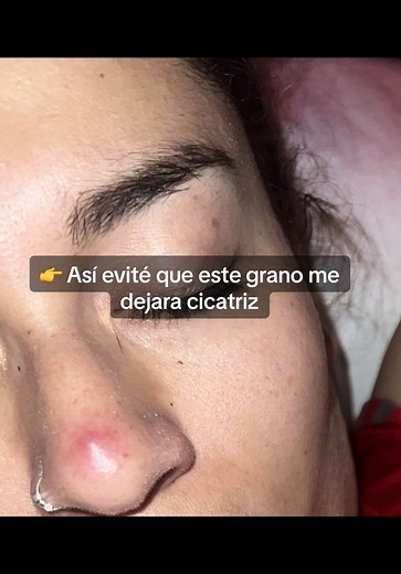 Superé un grano sin cicatriz: ¡mi arsenal de cuidados!
