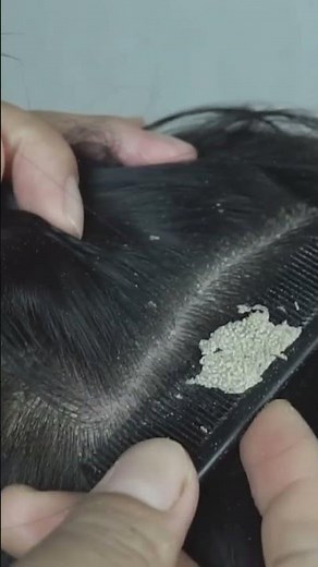 Quick and Easy Removing Scratching Big Dandruff Flakes