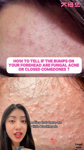 Korean Beauty Point | Korean Skincare & Makeup Store🇳🇵 | Closed comedones vs fungal acne. Let’s break it down 🧴👇 Closed comedones = clogged pores (oil + dead skin) Fungal acne = overgrowth of... | Instagram