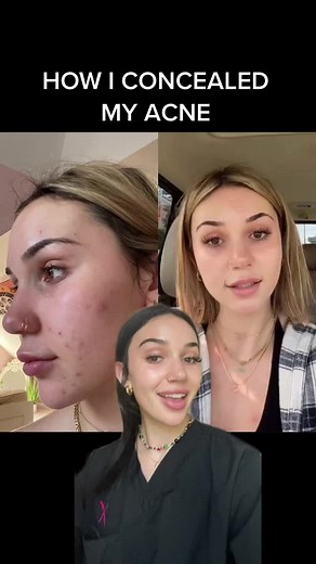 Concealing Acne with Dermablend: A Full Coverage Makeup Tutorial
