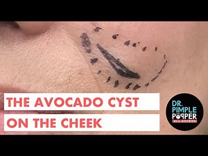 The Avocado Cyst on the Cheek