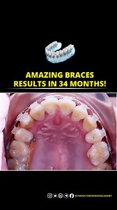 Braces treatment usually takes 12 to 24 months for most people 🦷 But the time depends on how your teeth are. 🙂 Mild cases (small gaps, slightly crooked teeth): 6–12 months 😐 Moderate cases: 12–18 months 😬 Severe cases (big gaps, rotated teeth, bite problems): 18–24 months Every smile is different, so treatment time can change for each person ✨ #braces #bracestreatment #dentalcare #orthodontics #smilejourney #teethcare #oralhealth #healthysmile | The Doctorpreneur Academy