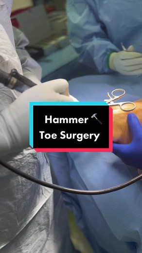 ✨Hammer Toe Surgery✨#surgery #hammertoe#toesurgery#edutok #theofficialtiktoktoedoc #beforeandafter #fyp #footsurgeon