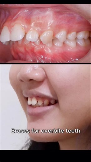 Braces fix overbite teeth and fix your smile :) #braces #orthodontist #dentist #smile #overbite