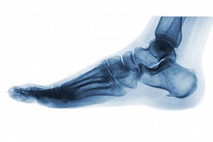 Achilles bursitis - AOA Orthopedic Specialists