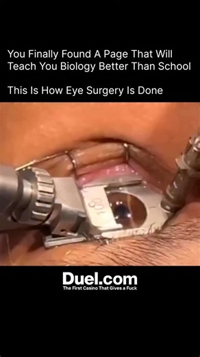 BIOLOGY | MEDICAL | HEALTH on Instagram: "Eye surgery is a highly precise and safe medical procedure performed by specialists called ophthalmologists. First, the eye is numbed so you feel no pain. Then, using advanced microscopes and laser technology, the surgeon gently corrects or repairs the part of the eye that needs treatment. Whether it’s removing a cataract, reshaping the cornea for vision correction, or repairing a retinal issue — every step is done with extreme accuracy. Modern technique