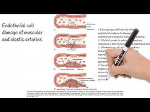 Atherosclerosis - Causes, Pathogenesis, Prevention