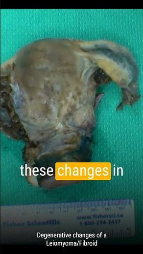 Understanding Leiomyomas Diverse Shapes and Forms