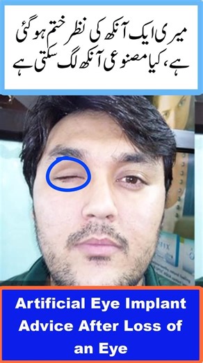 Artificial Eye Implant Advice After Loss of an Eye (Urdu/Hindi)