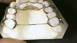 CBS Mornings:Feds launch criminal investigation into "AGGA" dental device and its inventor