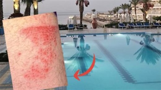 Urlauber machen Fehler in Ägypten - Hotelgäste klagen nach Pool-Besuch über Ausschlag
