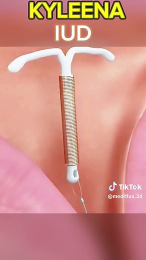 Kyleena IUD: Insertion, Removal, and Pregnancy Journey