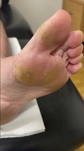 Gentle and Effective Big Toe Callus Removal by Australian Podiatrist