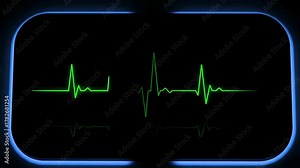 Heartbeat monitor displaying a normal electrocardiogram changing to a flatline on a monitor screen, medical animation
