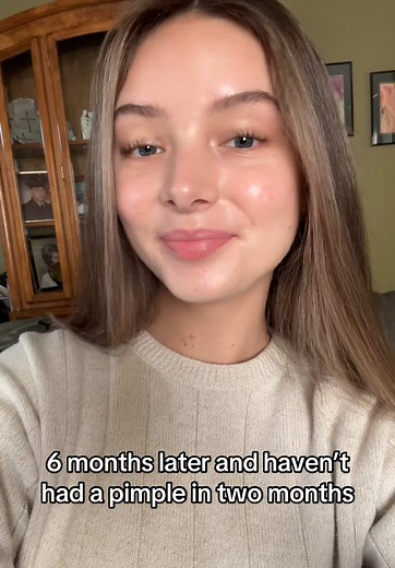 Transforming Skin: My Accutane Journey Success