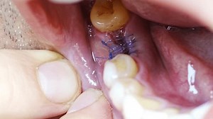 Close-up Sutured Socket Oral Cavity After Stock Footage Video (100% Royalty-free) 3603375957 | Shutterstock
