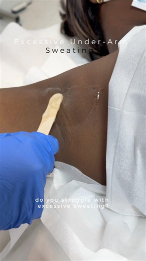 Excessive underarm sweating treatment with HIFU ✨