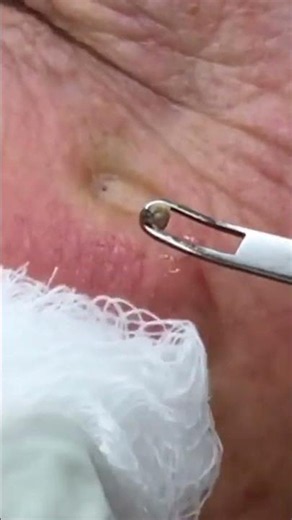 This blackhead extraction is so easy to watch