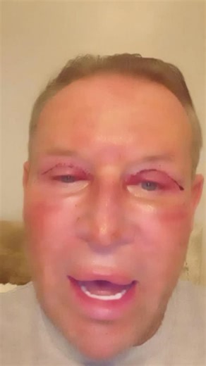 Had today Fractional co2 laser treatment and blepharoplasty Carnt wait to show you all my results!! They are going to be fantastic Beyondbeautiful Aesthetics Joanne McDonald | Philip Regan New