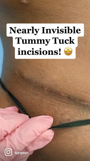 I am a Tummy Tuck specialist and I am known for my nearly invisible incisions! 😍❤️‍🔥 #lifechanging #beforeandafter #transformationchallenge #fyp #scar #beverlyhills #transformations #surgeon #rodeodrive #plasticsurgery #plasticsurgeonsoftiktok